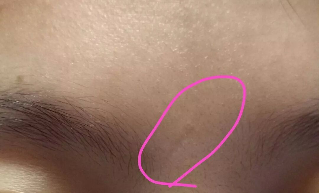 你知道男人的印堂有疤命运状况会如何吗