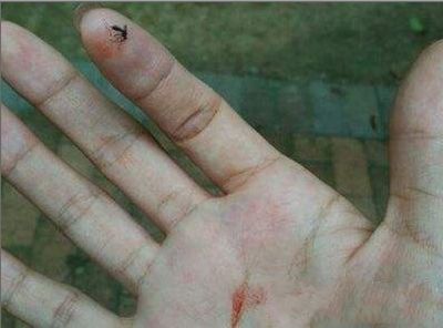 当蚊子吸食你的血液时,千万不能打死它,多年后才知道原因