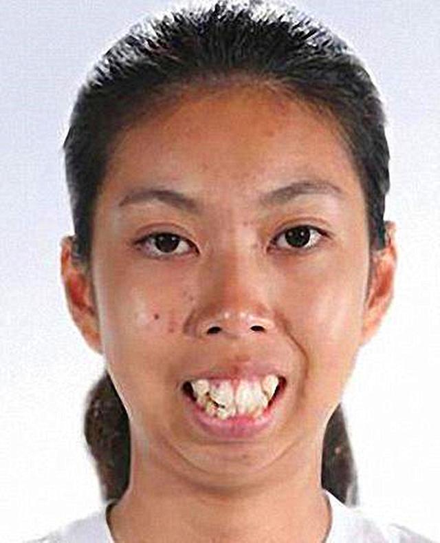 泰国19岁女子长得太丑找不到男友,整容后变成了这样!