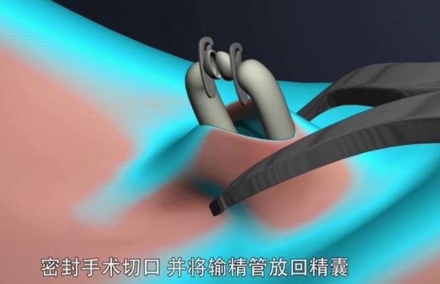 男性结扎术是咋做的组图播放全程网友简单以后让男人扎吧