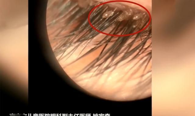 5岁女童眼睛瘙痒,医生从眼里取出20多只虱子,家长需要注意