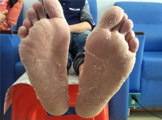 血糖高不高,低头看一下双脚,若没出现这几种情况有利于病情