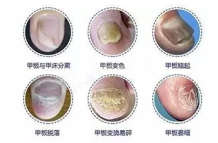 灰指甲怎么得的?医生提醒:3种治疗,一种最有效,保障指甲靓丽|灰指甲|癣病|真菌_新浪新闻