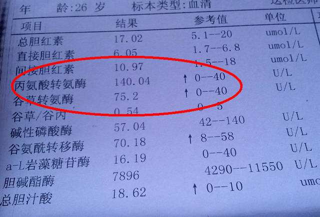 肝纤维化评分有4级,f3及时发现抗乙肝,能够减少难度