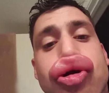 男子为了丰唇,抓来黄蜂蛰嘴唇,结果他有了最性感丰满的大嘴唇子|黄蜂|