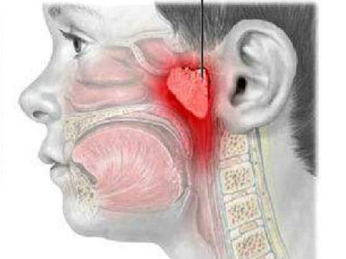 临床上扁桃体癌的鉴别诊断