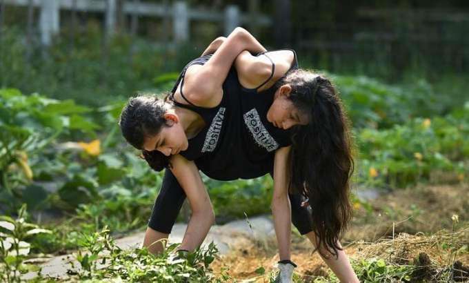 在医生帮助下,改变了自己的命运|医疗|连体|三胞胎_新浪新闻