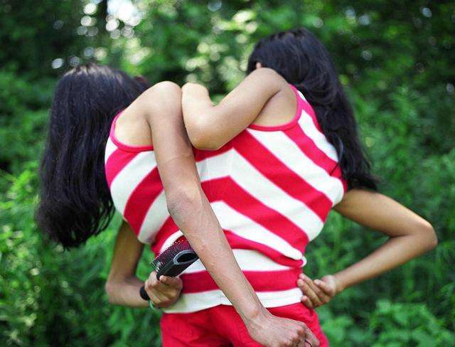 胞胎姐妹花,在医生帮助下,改变了自己的命运|医疗|连体|三胞胎_新浪