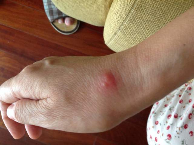 手上若出现这3种迹象,说明糖尿病可能要来了!