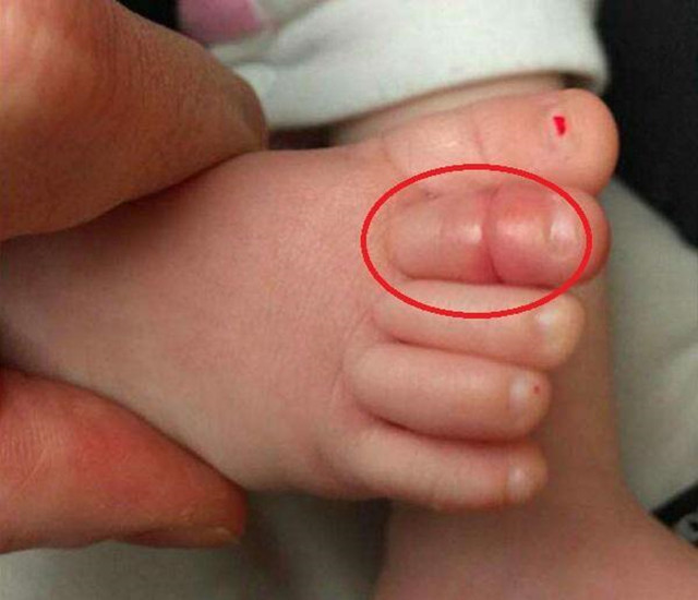4个月宝宝脚趾险些废掉,只因宝妈爱炫耀,医生:幸亏发现得早