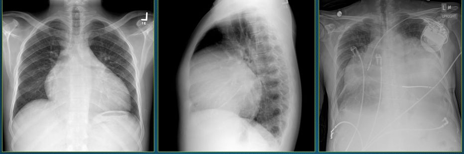 可以从胸片上来诊断,比如在胸片上可以看到类似球形心的改变.