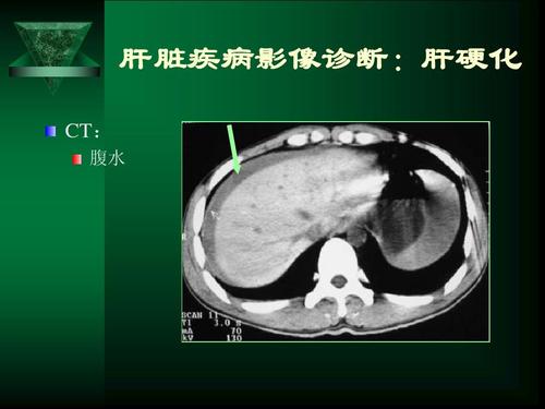 鉴别乙肝复发典型黄疸肝脾肿大和肝功能减退有关联性
