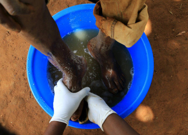 医生会将患者的脚部皮肤割开,取出沙蚤,再进行消毒,过程十分痛苦.