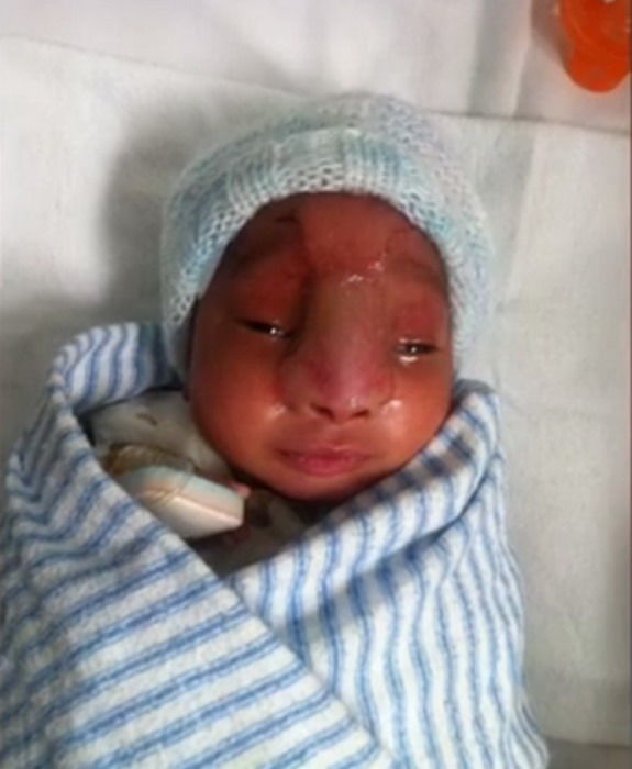 婴儿的大脑长在鼻子上,这样的孩子你敢生不,人家就敢生下来