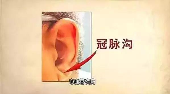 耳朵上出现这条沟,预示冠心病可能来袭