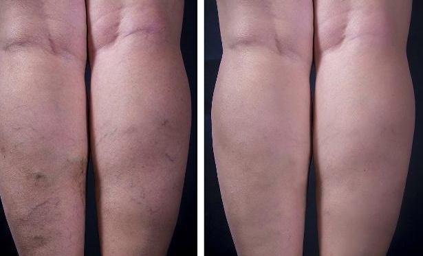 女性长期穿高跟鞋,会得静脉曲张吗?