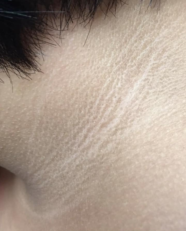 脖子脏脏的女童,诊室大口喝奶茶 医生警告:这是糖尿病前兆|胰岛素|棘