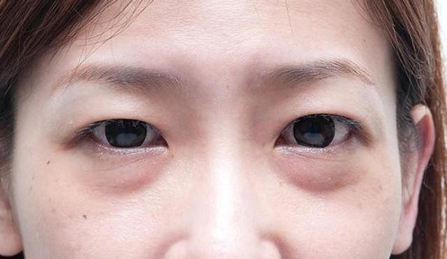 30岁的女人,眼袋下垂很显老?