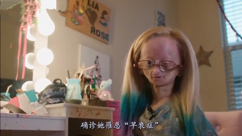 所谓的早衰症,全称哈钦森-吉尔福德早衰症,又称儿童早老症