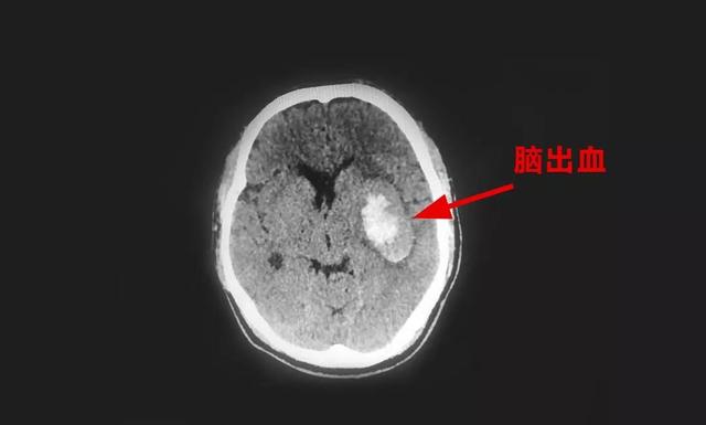 中年企业主三夜不寐突发脑出血 术后直言"不敢再这么拼了"