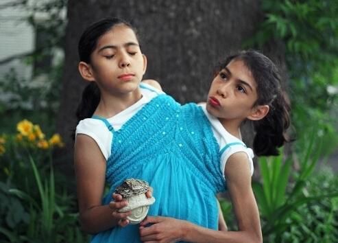 如果连体人其中一个去世了另一个还能活吗看完莫名心疼