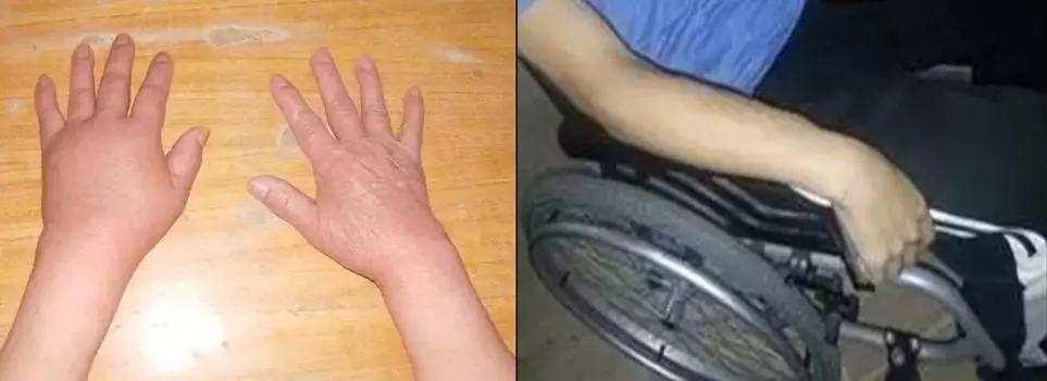 开封市中心医院康复健康助力行——肩手综合征的康复治疗