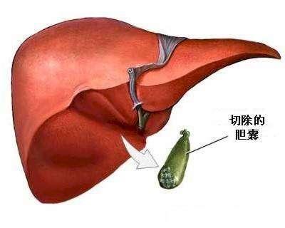 胆囊炎不治疗并发症很严重发病早期还可以选择这样保守治疗方式