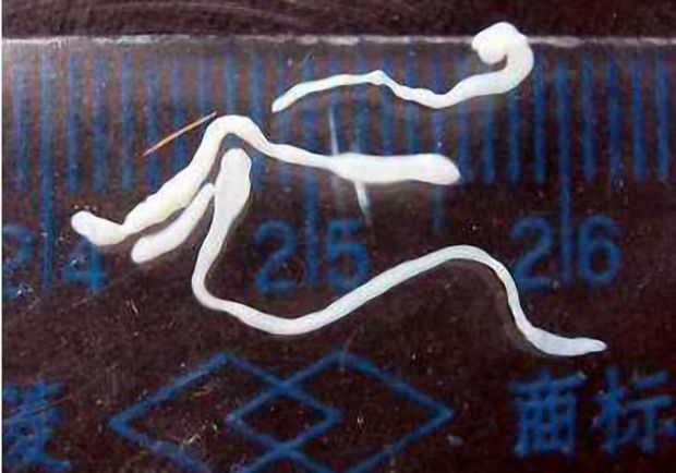 男孩头痛,医生从他脑中取出10厘米虫子,原来他吃过这东西