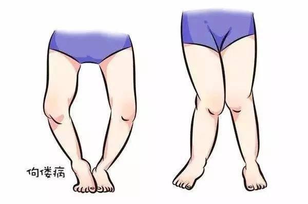 儿科医生告诉你如何预防宝宝罗圈腿!