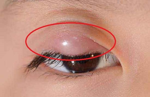 女孩总揉眼睛还说痒,父母带她去医院检查,竟取出了20多只虱子