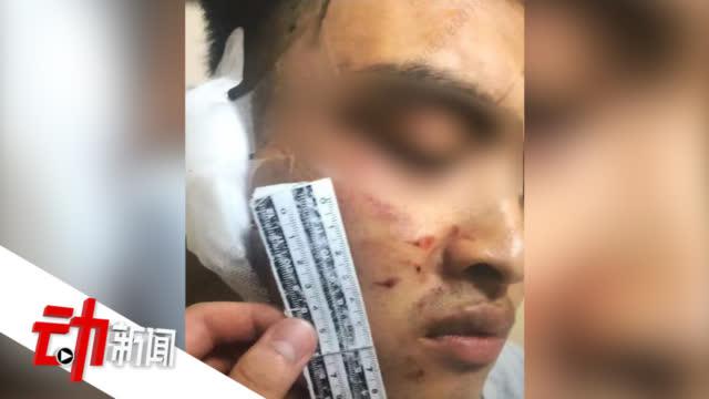 1年前借20元烟钱没还 男子被同事咬掉一半耳朵