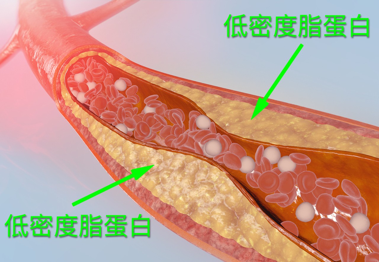 "低密度脂蛋白"胆固醇高?只要1招,让你事半功倍,轻松降下来