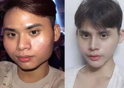 外国男子花4万多整容后吃1个月流食现对外表满意称痛苦也值得