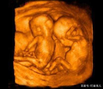 怀双胞胎有什么感觉?跟单胎有什么不同?这些信息孕妇要搞清楚|孕妇|双胞胎|胎儿_新浪新闻