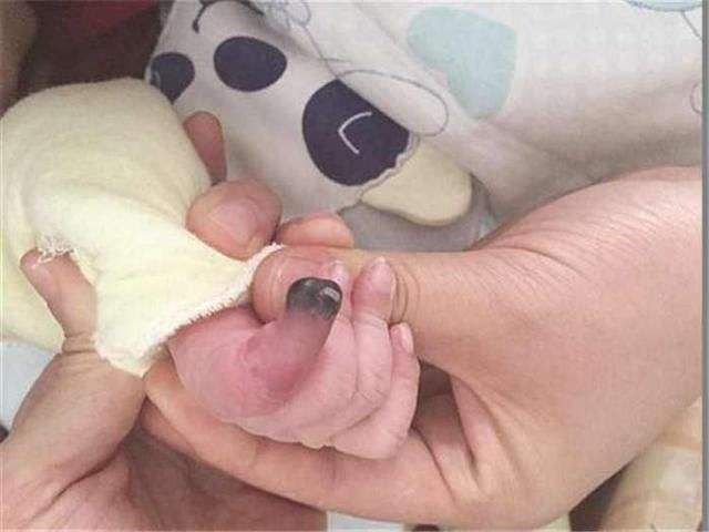 宝宝的总是挠自己的情况怎么办?新生儿真的能戴手套吗?