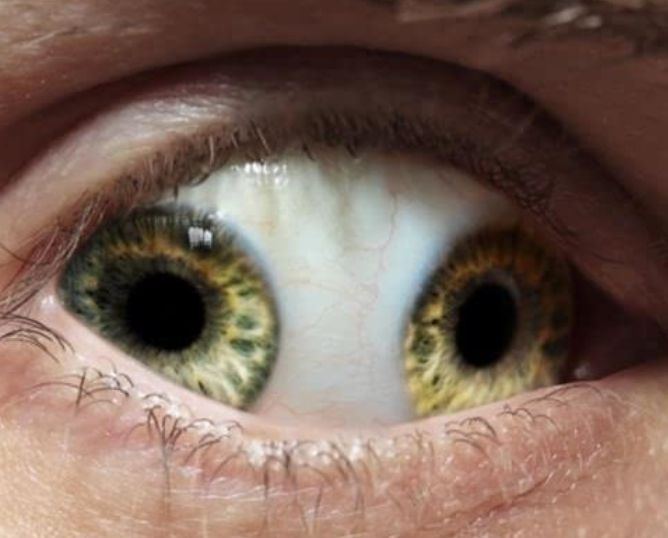 拥有"异瞳孔"的人,看东西会有什么影响,和普通人有什么不一样|瞳孔