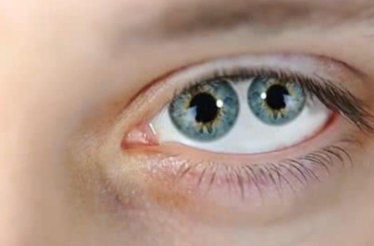 拥有"两个瞳孔"的人,他们看到的世界是啥样,可能你不敢想象