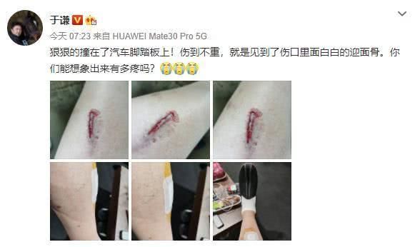 于谦法国出车祸腿部受伤,伤口深可见骨还不忘调侃自己伤不重