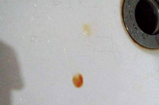 不咳嗽却痰中带血可能是这4种疾病来袭别不当回事