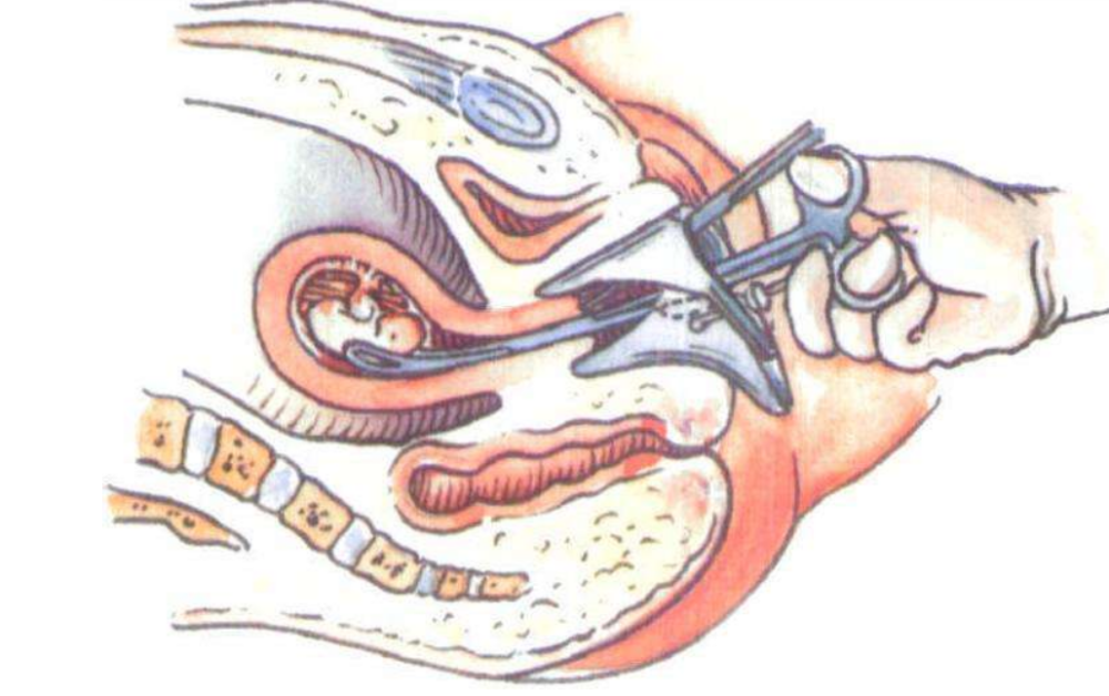 钳刮术1次据相关医学研究表明,一次人流,发生宫腔粘连的概率为6.
