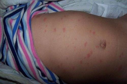 幼儿急疹又被称为婴儿玫瑰疹,是一种婴幼儿时期的急性出疹性传染病.