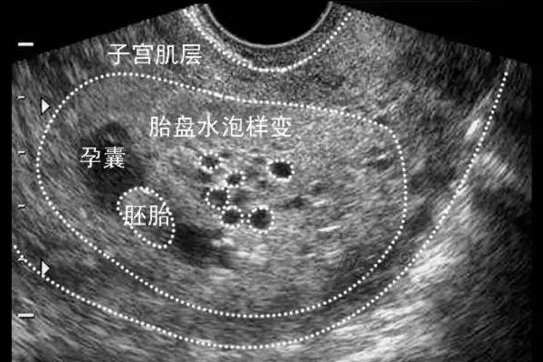 很有可能是先兆流产或者说孕囊在子宫中种植不稳