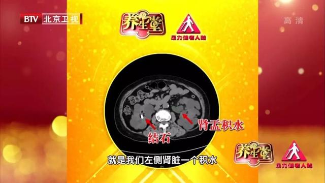 倒立可以排结石?别再被骗了!预防肾结石,这样最有效,还不花钱