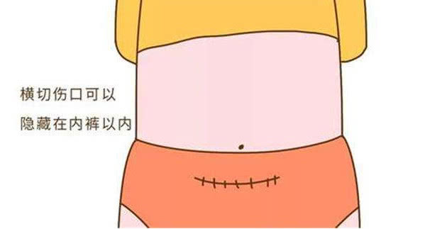 剖腹产切口位置图图片