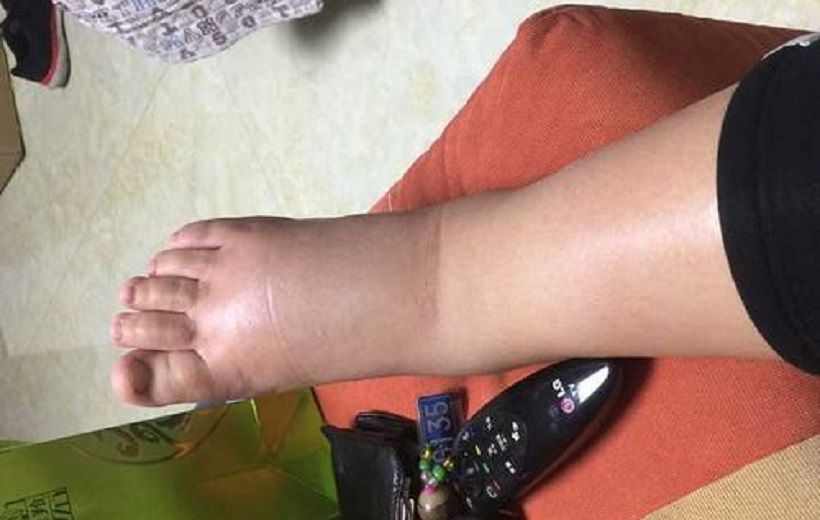 这种水肿的现象让大家非常的痛苦,是不是因为喝水多而造成的呢?