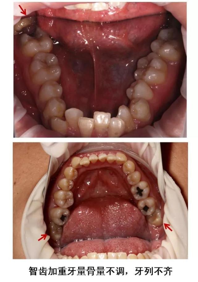 今天和你说清楚|智齿|拔牙|邻牙_新浪新闻