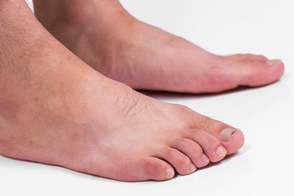 一到冬天易出现脚后跟干裂如何缓解