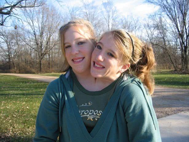 29岁美国连体姐妹会打垒球考出驾照当了老师,还计划着结婚生子