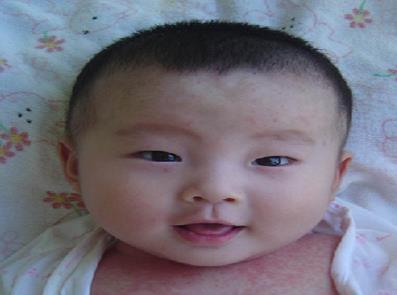 痱子季节到,家长要警惕松花粉纯天然的陷阱