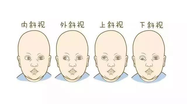 父母的视力都好,为什么孩子患有先天性斜视,弱视?